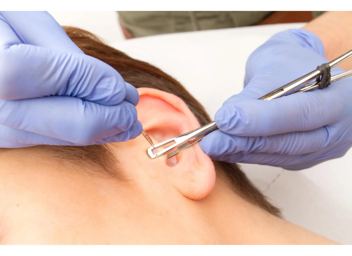 Migrén piercing árak - mennyibe kerül?