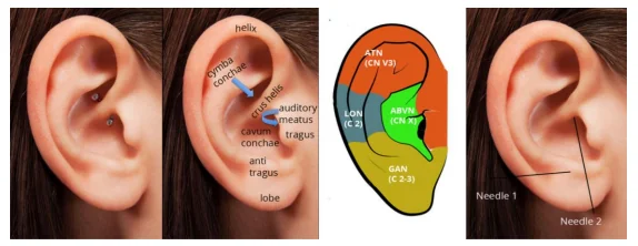Daith piercing kutatás! A vagus ideg stimulációja és a migrénkezelése
