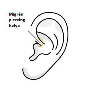 Migrén piercing helye