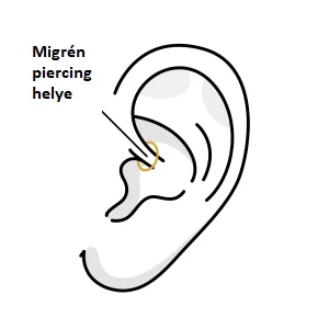 Migrén piercing helye - melyik fülbe és hova szúrják?
